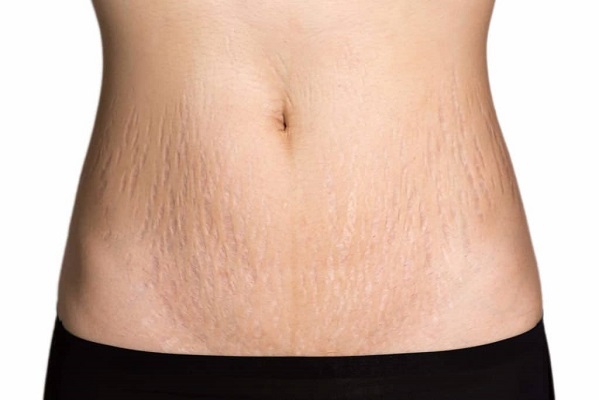 Smagliature: cosa sono e come prevenirle
